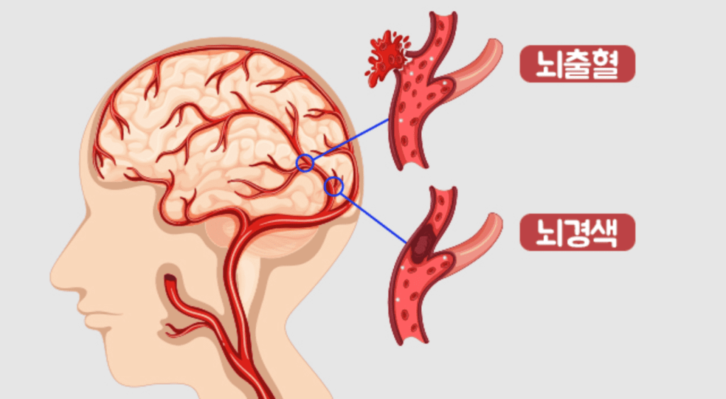 뇌졸중 종류 