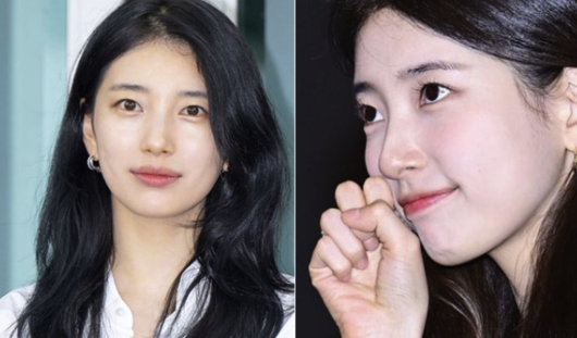 최근 결막모반 시술을 한 수지